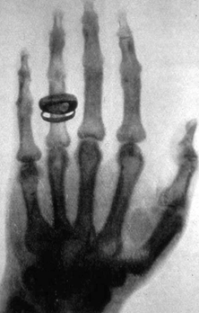 1896年にレントゲン博士が撮影した手のX線写真