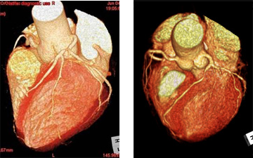 心臓に関するX線CT(左側)とMRI(右側)の画像